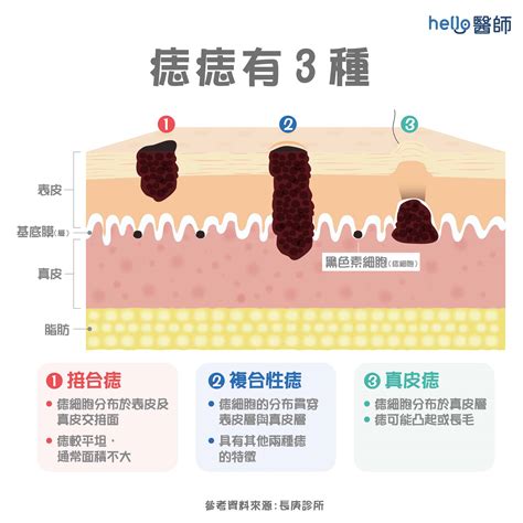 痣形成原因